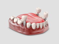etapes-realisation-bridge-dentiste-villepinte