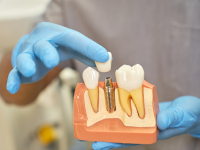 implants-courts-en-dentisterie-dentiste-villepinte